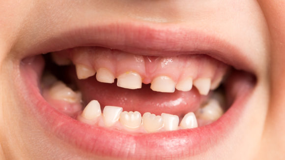 Le sigillature: prevenzione orale nei bambini